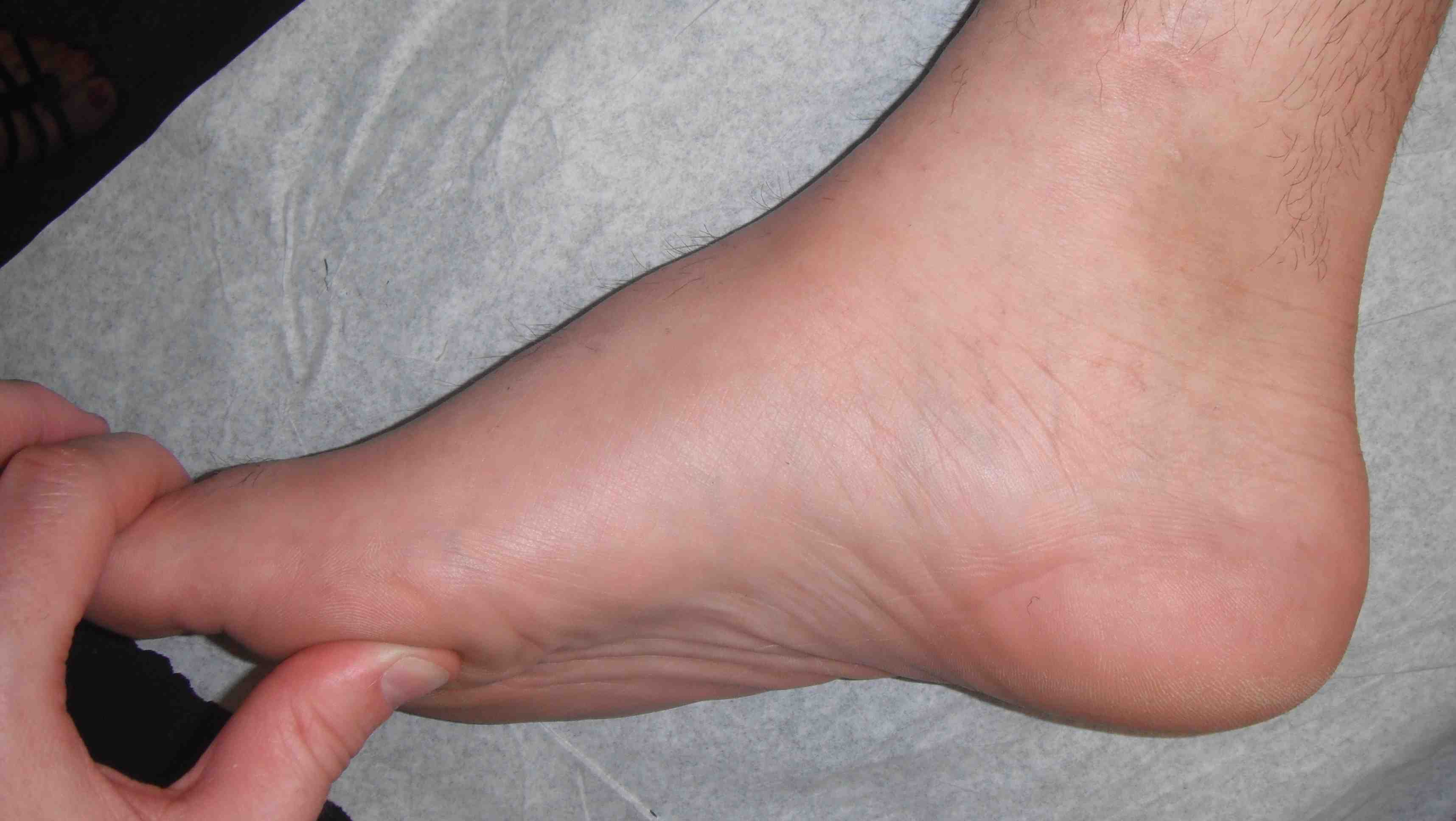 Cavus Foot Flexible First Metatarsal